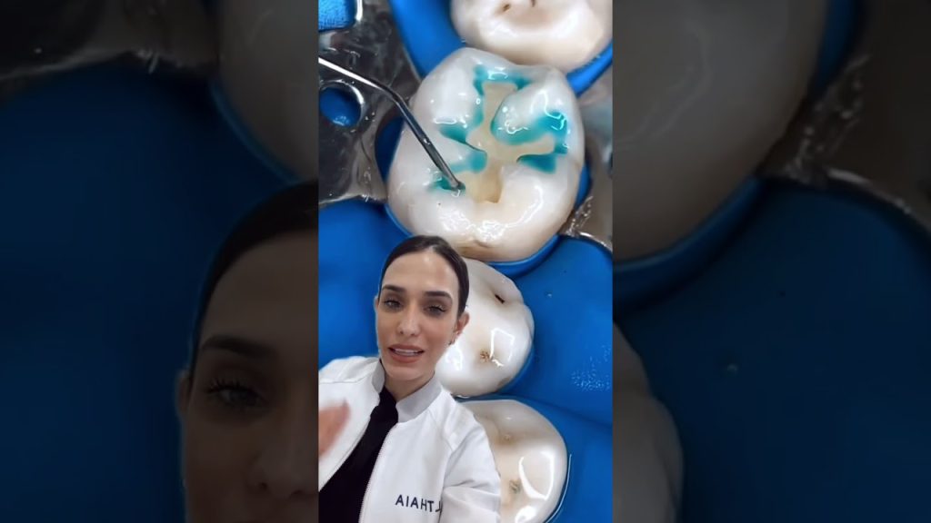 Ya conocían cómo se colocaba una resina?? #dentista #shorts #videoshorts #viral #ortodoncista